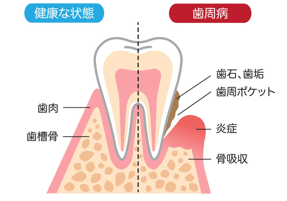 歯周病の原因